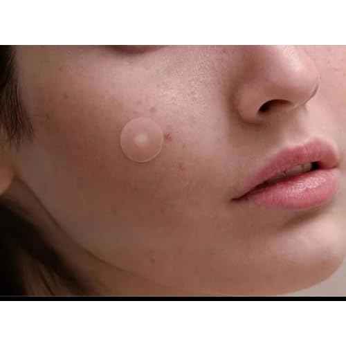 Acne Patches, 360 Count, Hydrocolloid Pimple Stickers, Breathable, Alcohol-Free, All Skin Types