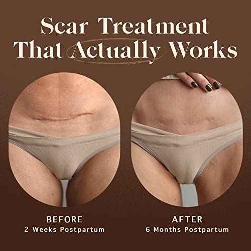 Nemah - Restorative Scar Treatment for C Section Recovery - C Section Scar Treatment for Postpartum - Reduces the Appearance of Scars from Acne - Vegan & Cruelty-Free - 1 oz.