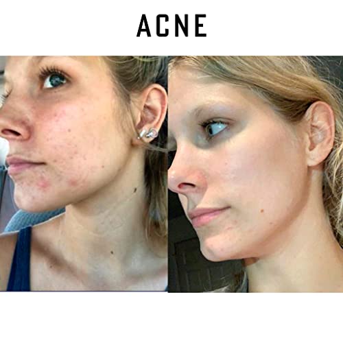 Pure Organic Ozonated Olive Oil Orginal Strength 800 Peroxide For Face and Skin Helps In Acne, Anti-Aging, Wrinkles and Rosacea For Sensitive Skin with Made in Spain