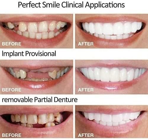 2 Pairs, Temporarily Adjustable for Men and Women, Regain Confidence Smile Teeth Whitening Kits(White) (1)