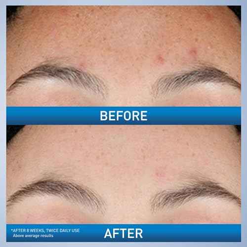 CeraVe Resurfacing Retinol Serum For Post Acne Marks, Formulated With Licorice Root Extract & Niacinamide, Brightening Serum & Pore Minimizer For Face, Post Acne Skin Barrier Repair, Non-Comedogenic