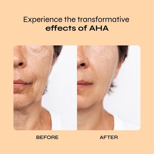 A-Cute Derm Ultra 10 AHA Anti-Aging Lotion for Exfoliation Simple and Effective for Face and Body (4 OZ)