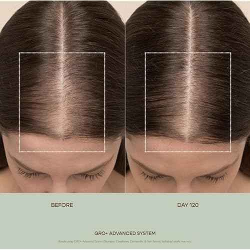 VEGAMOUR GRO+ Advanced Hair Serum for Hair Density, Reduces Shedding and Promotes a Healthy Scalp, Helps with Severe Signs of Thinning, Made Without Fragrance, Vegan, Cruelty-Free