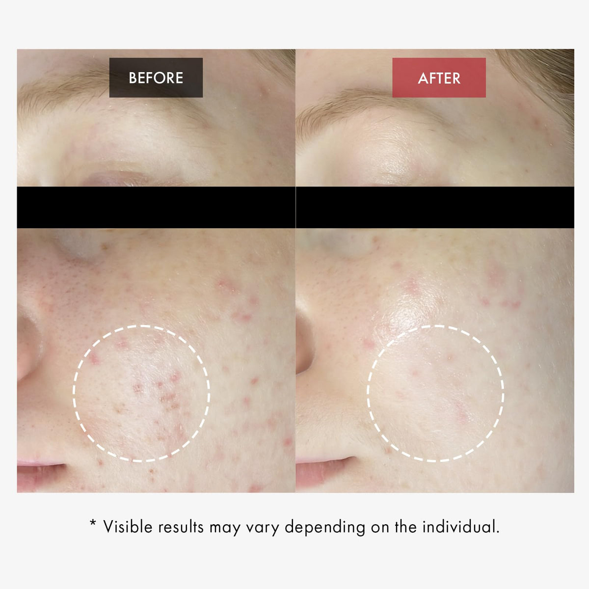 DR.WANT Red BHA Gel, AHA PHA LHA Exfoliating for Blemish-Prone Skin