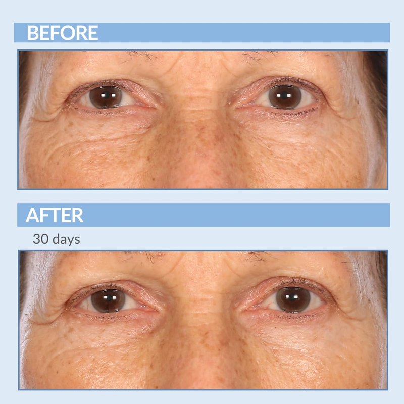 Serious Skincare - Retinol A Eye XR Under Eye Cream Concentrate - Reduce Fine Lines, Dark Circles & Puffiness - Daily Wrinkle Cream - Anti-Aging Skin Care Treatment for Women and Men - 0.5 oz