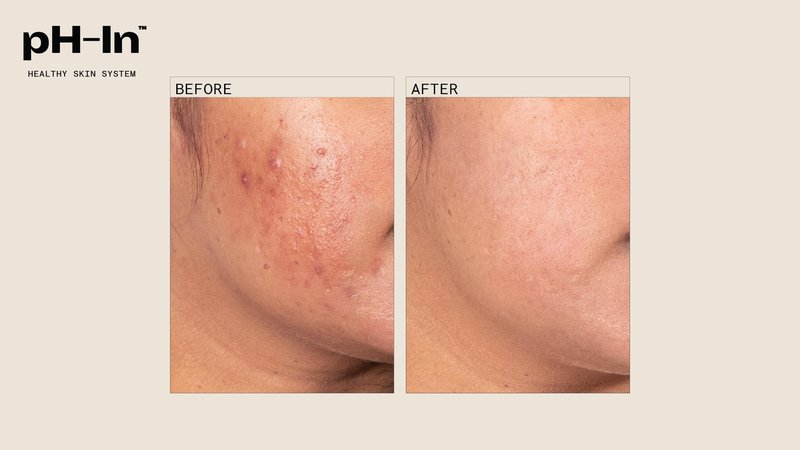 pH-In 3 Step Healthy Skin System