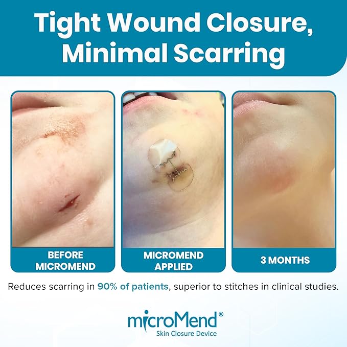 Emergency Wound Closures Surgical Quality Laceration Repair Without Stitches - Think Ahead - Be Prepared - Add to Your First Aid Kit, Camping Gear (Multi Pack - 3 Packs of 2 Medium Devices)