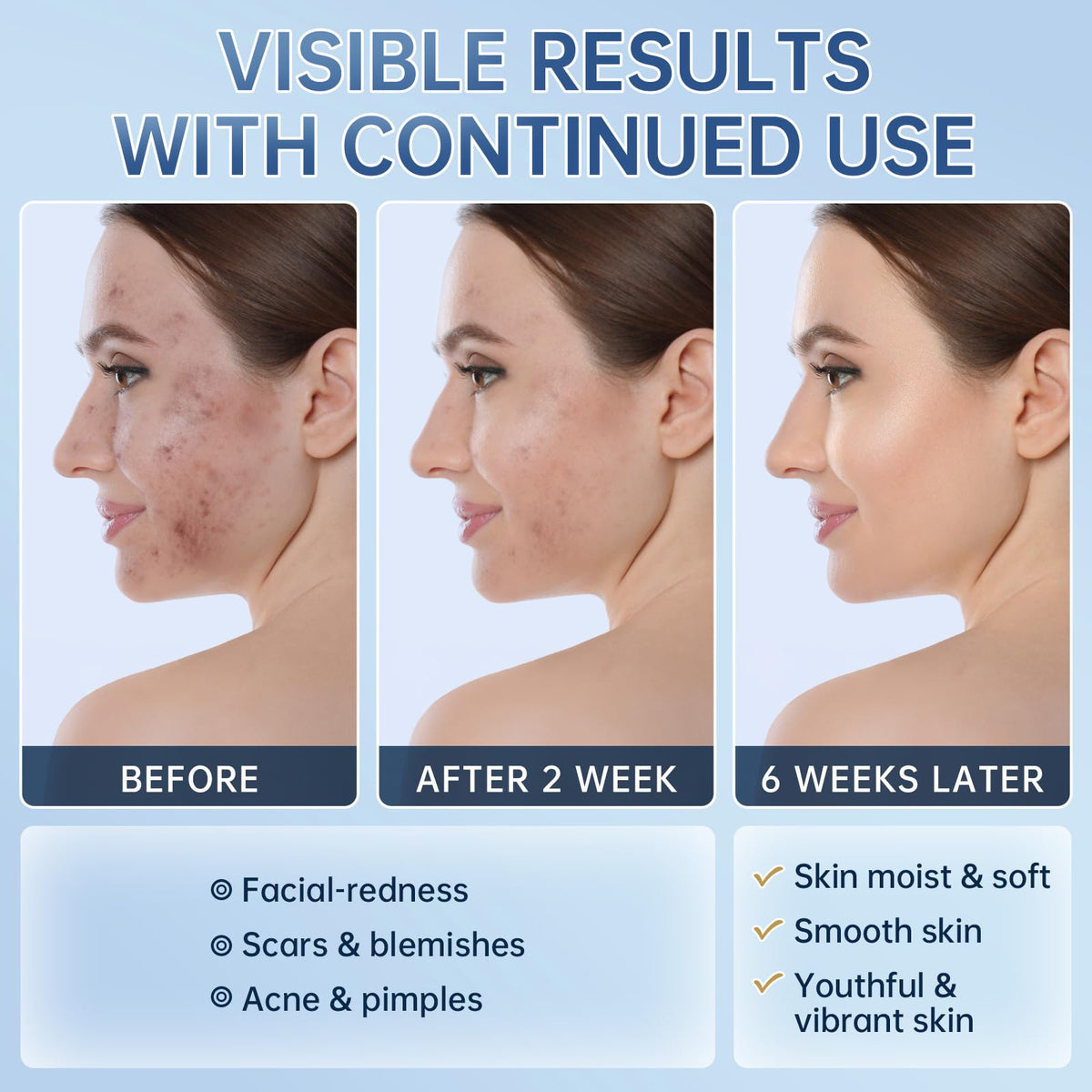Azelaic Acid 14% Acne Cream for Redness Relief, Dark Spots, Facial Serum with Niacinamide & Vitamin C Prevent Acne Breakouts, Azelaic Acid Serum for Balance Excess Sebum & Soothe Irritation, 2 Oz.