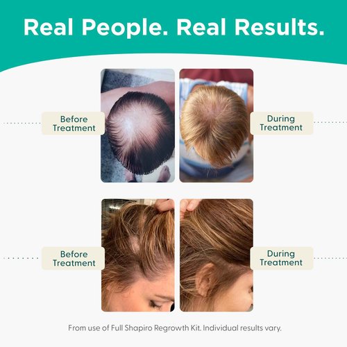 Shapiro MD Hair Growth Experts DHT Fighting Shampoo, Leave-in Conditioner, Leave-in Foam Hair Loss Bundle, Triple Action Thinning Hair Fighting Formula Developed, 1 Month Supply