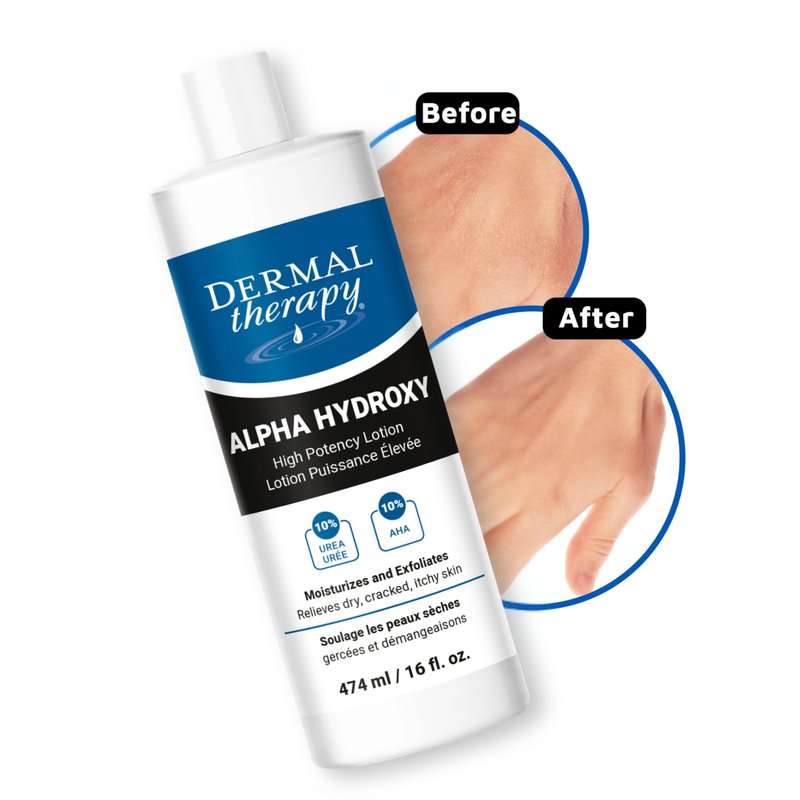 Dermal Therapy Alpha Hydroxy Lotion – 10% Urea + 10% Lactic Acid, Fragrance-Free Body Lotion for Dry, Cracked Skin, Non-Greasy Exfoliating Moisturizer & Keratosis Pilaris Treatment, 16 fl oz (474 ml)