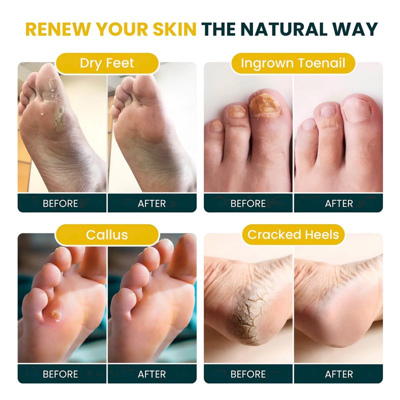 FOOT CURE Tea Tree & Citrus Foot Soak with Epsom Salt – Supports Tired Feet, Softens Calluses, and Refreshes (Pack of 2)