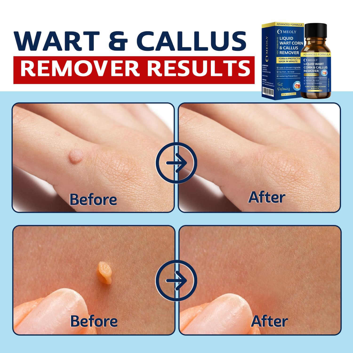 MEOLY Fast-Acting Wart Remover: Salicylic Acid Wart Remover for Plantar Wart, Corn Fast-Acting for Men and Women 30 ML