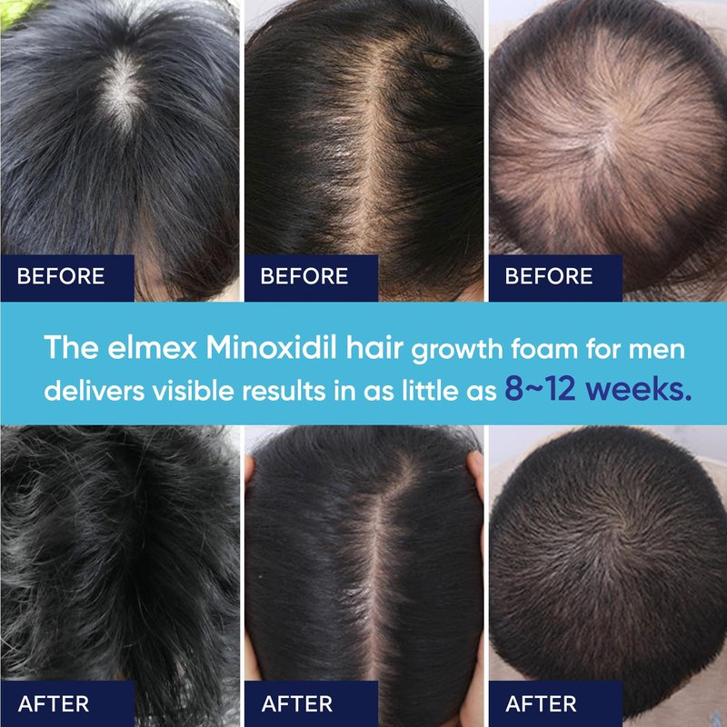 5% Minoxidil Foam for Men and Women, Minoxidil for Men Foam for Hair and Beard, Minoxidil for Women Hair Growth (6 Ounce)