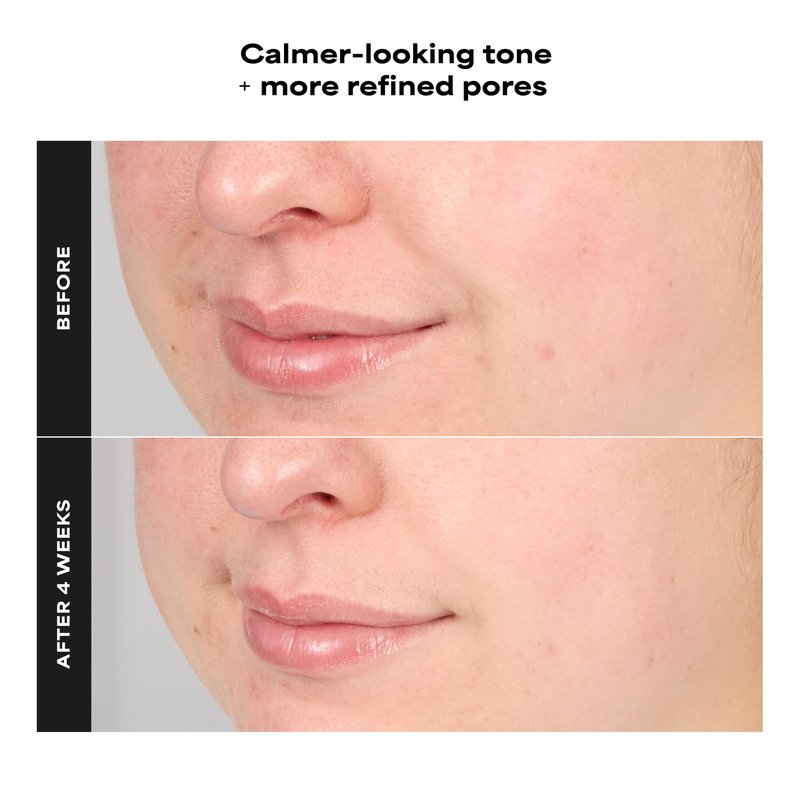 Paula's Choice RESIST Advanced Pore Refining Treatment 4% BHA Serum, Face Exfoliator with Salicylic Acid, Green Tea, Anti-Aging Exfoliant for Oily, Normal, Combination Skin, Fragrance-Free, 1 Fl Oz.