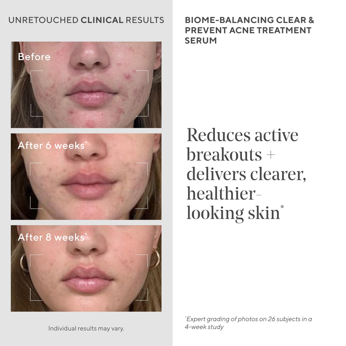 Murad Biome-Balancing Acne Treatment – Salicylic, Mandelic, and Glutamic Acid Serum for Clearing and Preventing Breakouts, Decongesting Pores, and Balancing Skin Microbiome – 1.0 Fl Oz