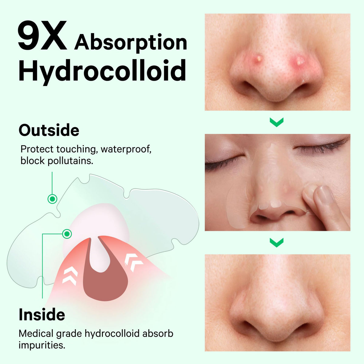 Sosky Hydrocolloid Pimple & Pore Patches for Nose, Absorb Oil Overnight, Target Pimples, Zits and Pores, FSA Eligible Acne Patches, Clear Skin, 14 Count