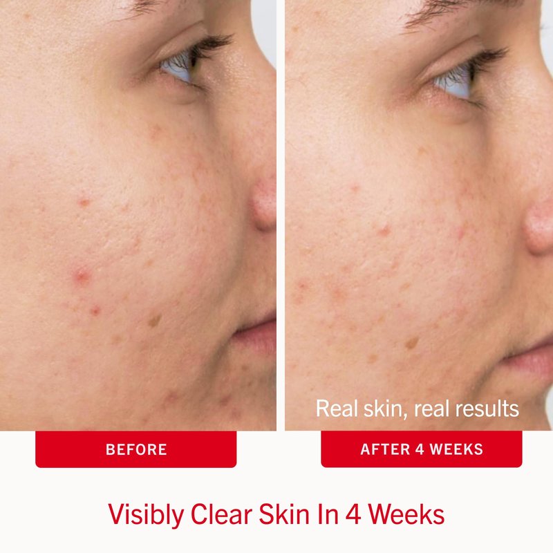 First Aid Beauty Acne Treatment Pads, 2% Salicylic Acid Maximum Strength Acne Pads for Face, Non-Drying Formula, Sensitive Skin, 60 ct