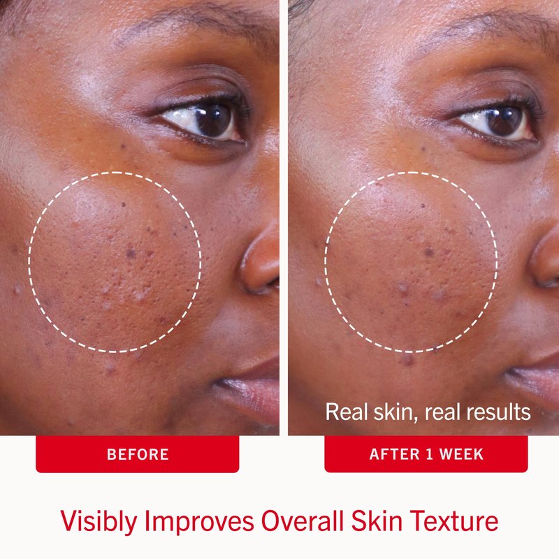 First Aid Beauty Acne Treatment Pads, 2% Salicylic Acid Maximum Strength Acne Pads for Face, Non-Drying Formula, Sensitive Skin, 60 ct