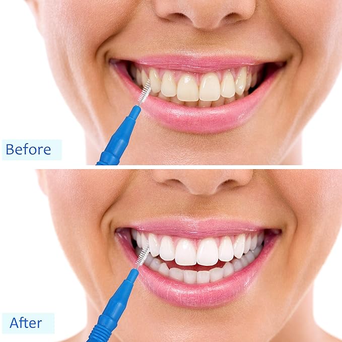 BBTO 100 Pcs Braces Dental Brush Flosser for Cleaner Interdental Brush Toothpick Tooth Flossing Head Oral Dental Toothpick Cleaners Cleaning Tool(Orange and Blue)