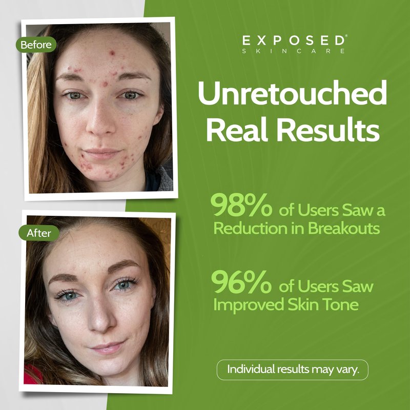 Exposed Skin Care, Acne Facial Cleanser with 0.5% Salicylic Acid for Sensitive and Acne-Prone Skin – Gentle Daily Face Wash for Breakout, Blackhead and Excess Oil – Natural, Non-toxic and Cruelty Free