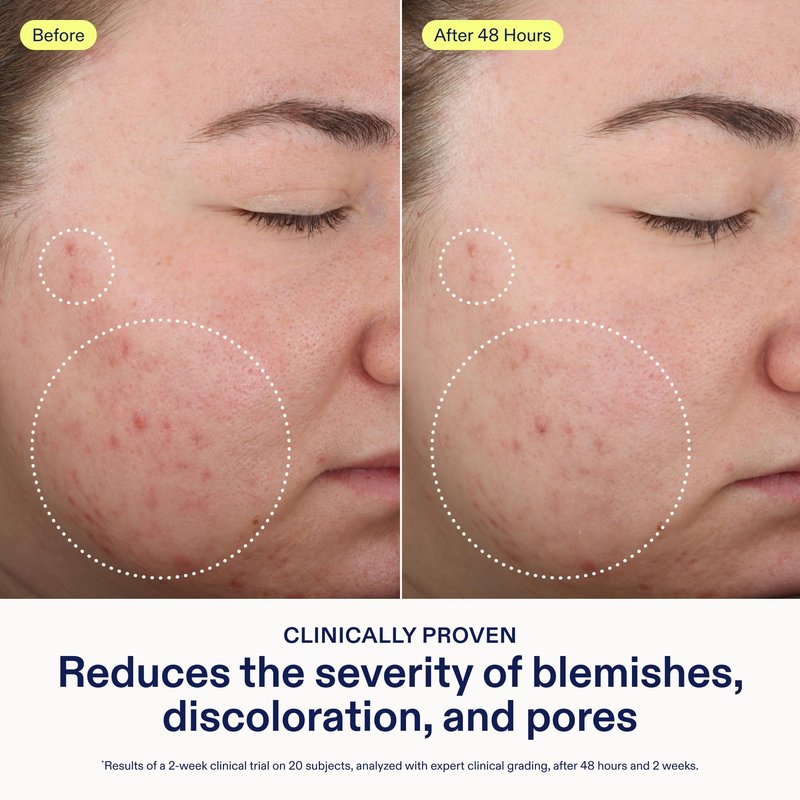Skinfix 2% BHA Cleanser - 5 oz - Clears Acne Blemishes & Blackheads - Safe for All Types of Acne - Fragrance Free - Vegan, Cruelty Free