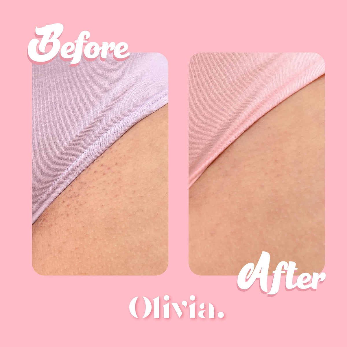 Olivia Aurora Bikini Scrub – Sweet-Scented Exfoliant for Intimate Area – Prevents Ingrown Hairs, Fades Dark Spots & Smooths Skin – Natural, No Sugar, 8 oz