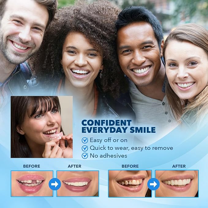 Imako Premium Cosmetic Uppers - 1 Pack - Large, Natural White - DIY Smile Makeover - Made in USA
