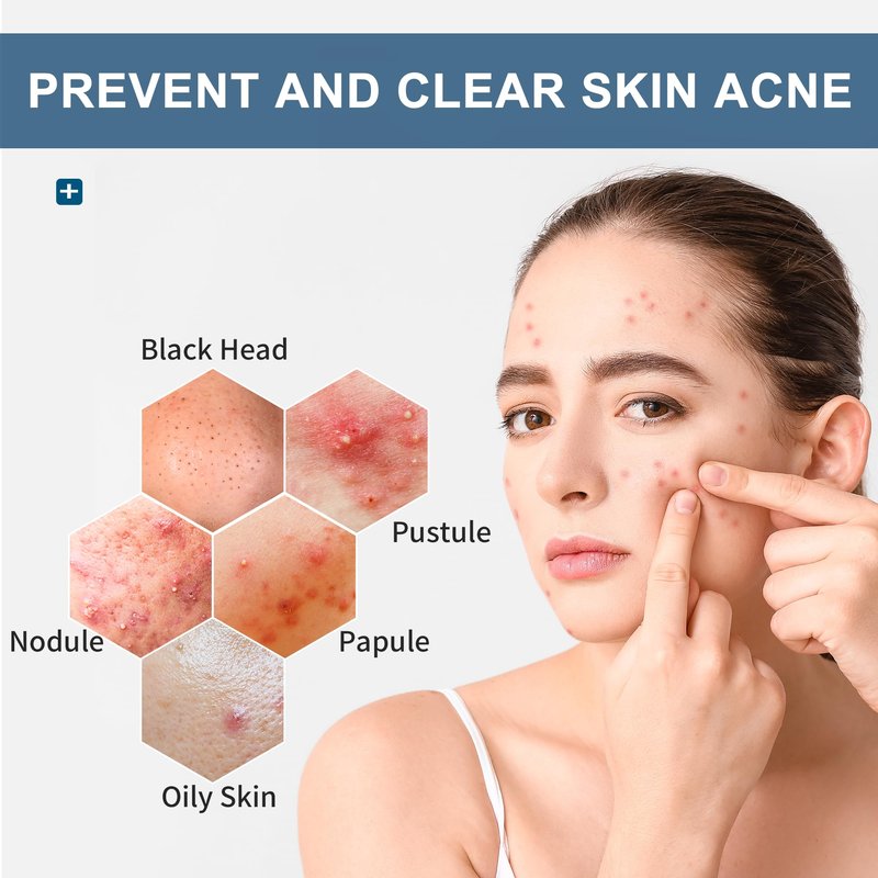 Natouch Acne Wipes for Face & Back, Acne Treatment Wipes with Salicylic Acid, Acne Scars and Dark Spot Remover with Natural Essential Oil for Face, Body, Back, and Butt