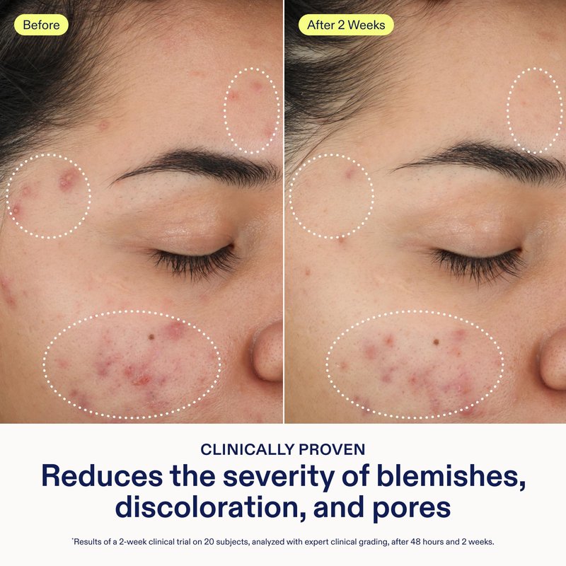 Skinfix 2% BHA Cleanser - 5 oz - Clears Acne Blemishes & Blackheads - Safe for All Types of Acne - Fragrance Free - Vegan, Cruelty Free