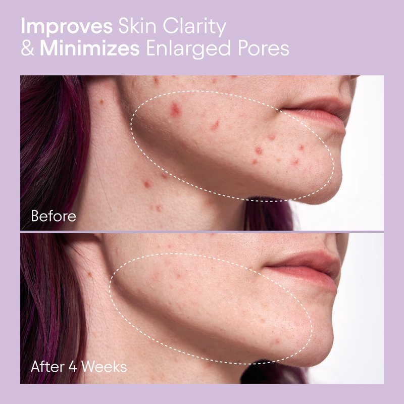 Alpyn Pore Perfecting Liquid Toner with 2% BHA & Borage | Liquid Exfoliator to Minimize Pores, Calm & Restore Skin's Natural pH | 4 oz / 120 ml